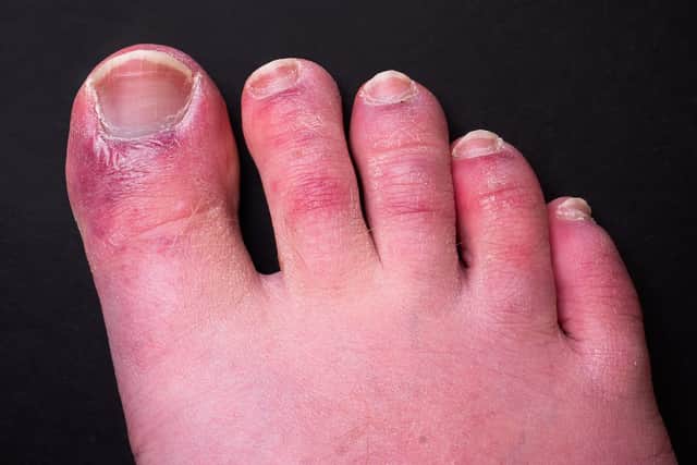 The symptoms of Covid toes include chilblain-like inflammation and redness on the hands and feet (Photo: Shutterstock)