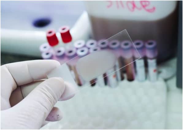 Sickle cell disease is the name for a group of inherited health conditions that affect the red blood cells (Photo: Shutterstock)