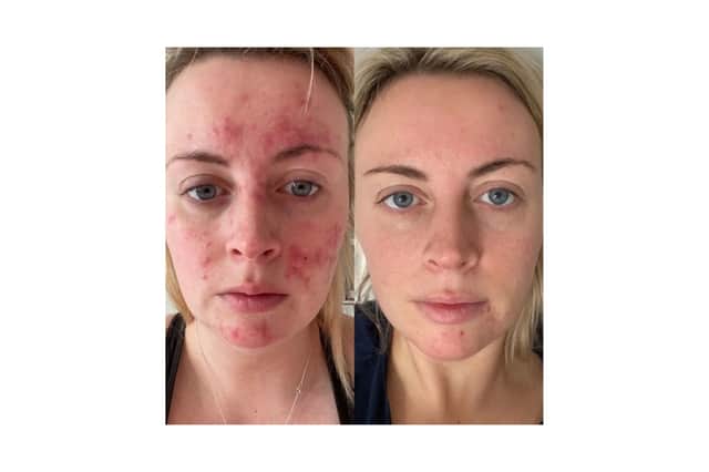 Abigail's results with 47 Skin
