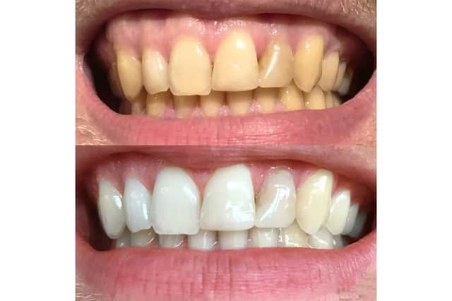 Smile Pro’s award-winning Advanced Whitening Kit