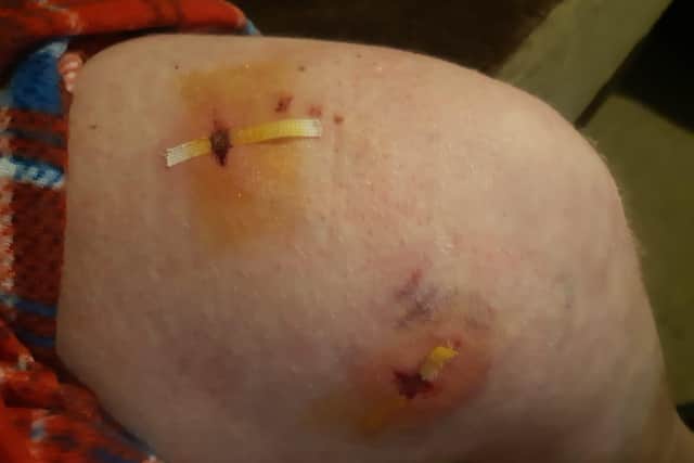 Charlie's fiance was left with these injuries after being attacked by a dog