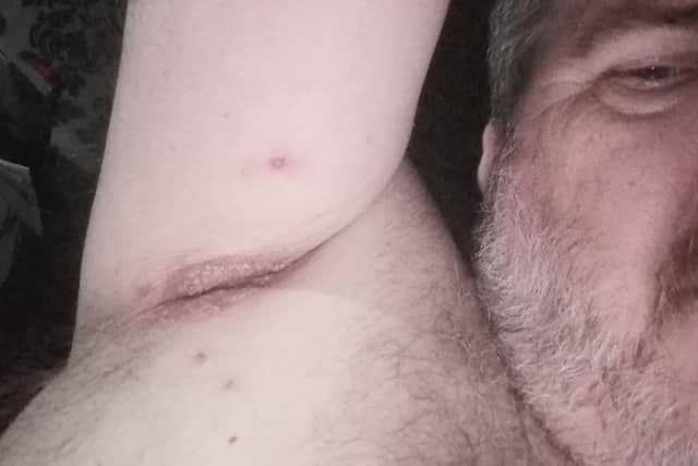 Andy wants to warn others after a rash appeared under his arm after he had the booster vaccine