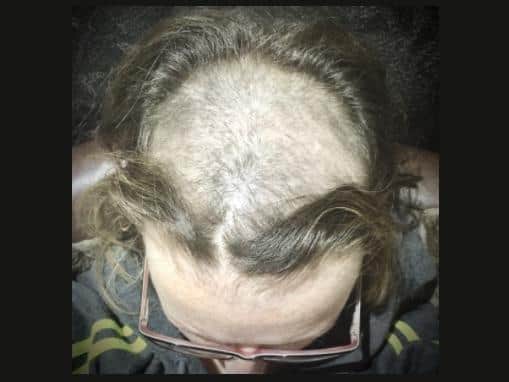 Emma lost her hair when she had chemotherapy during her battle against cancer