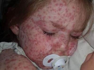 When little Emily Reavley was covered in red spots, mum Emma suspected it was chickenpox. Credit: Kennedy News and Media