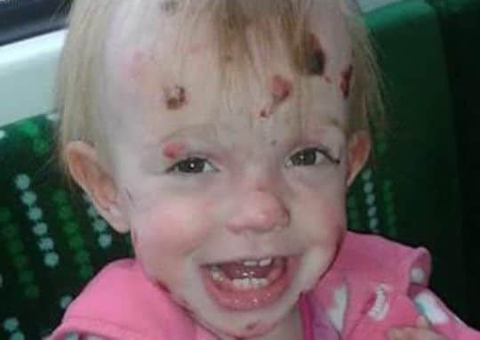 Tia suffers from a rare skin condition.