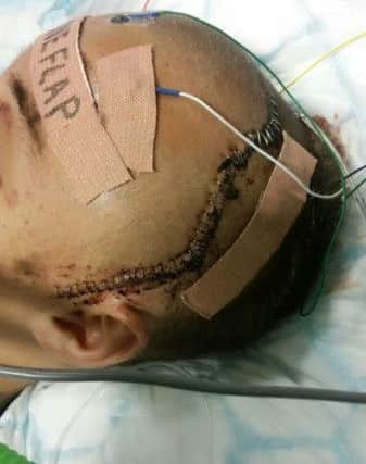 Christian-Lee Thompson had to have 87 stitches in his head