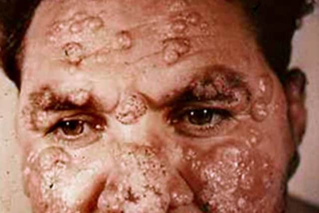 The disfiguring effects of leishmanianism. Otis Historical Archives, CC BY